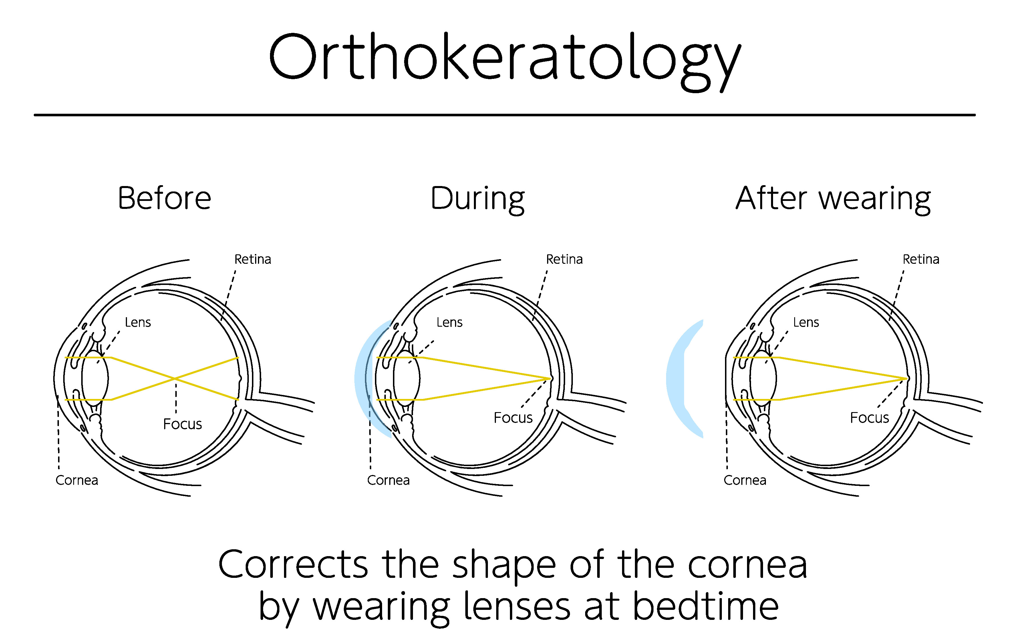 ortho-k description